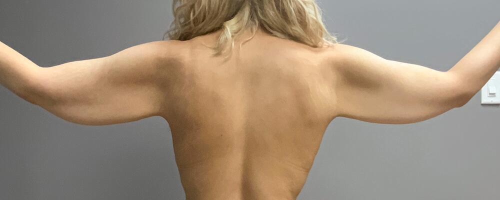 Arm Lift Before & After Image